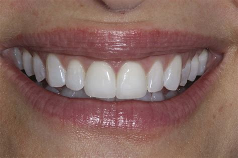 porcelain veneer.